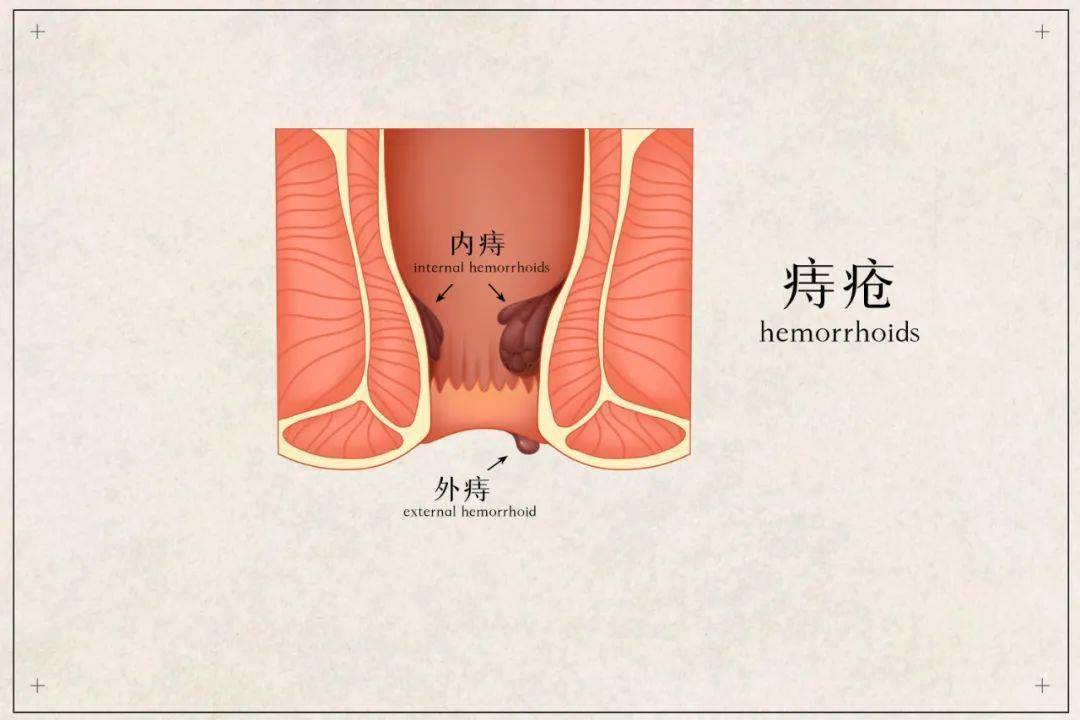 为什么有那么多人不愿意做痔疮手术