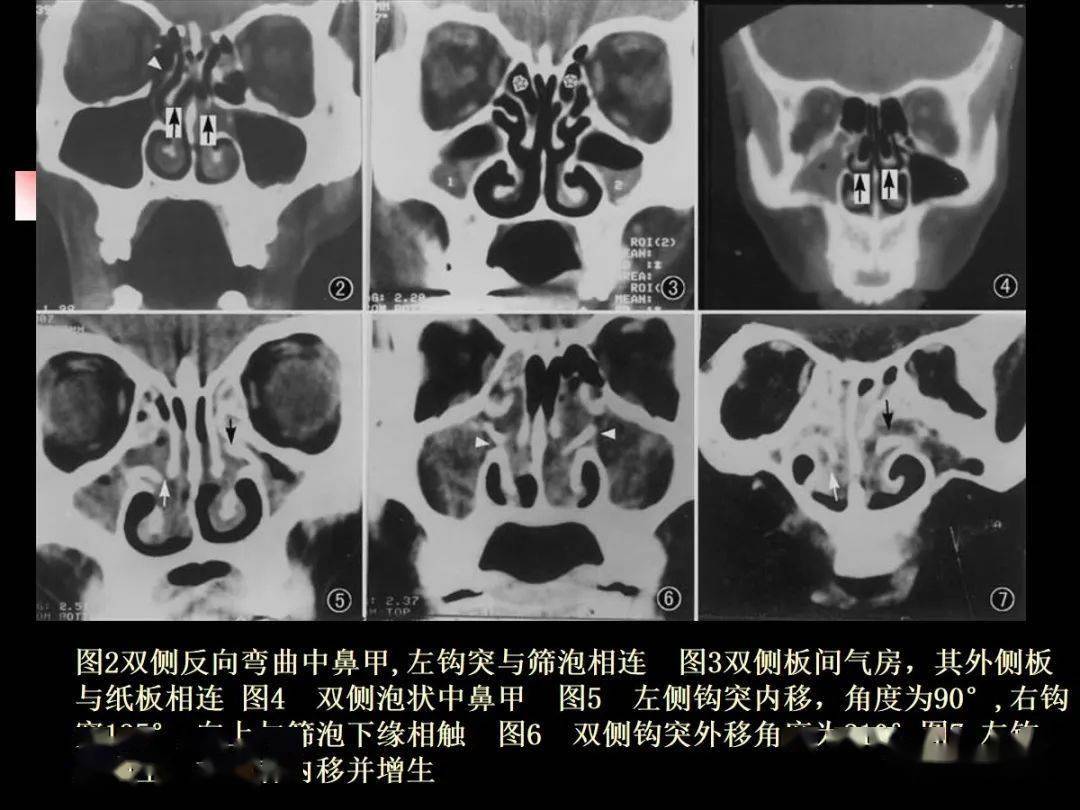 鼻及鼻窦影像解剖及相关疾病影像诊断