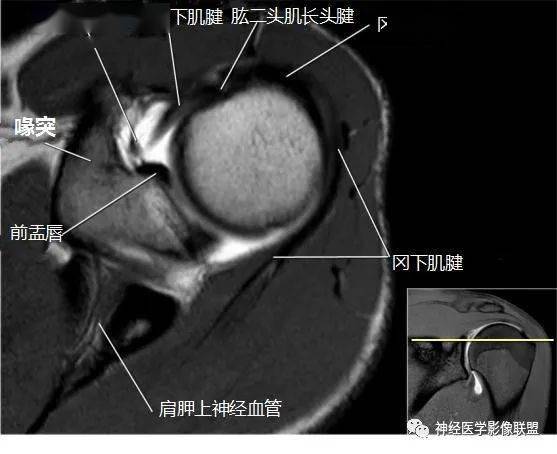 断层解剖 | 肩关节磁共振