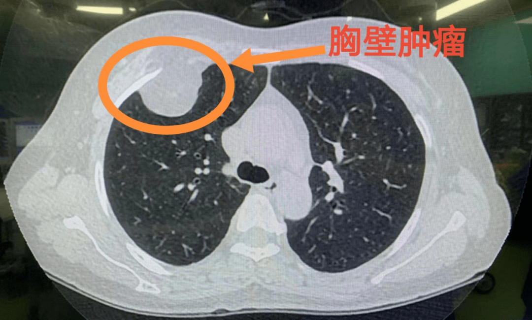 胸壁肿瘤ct图