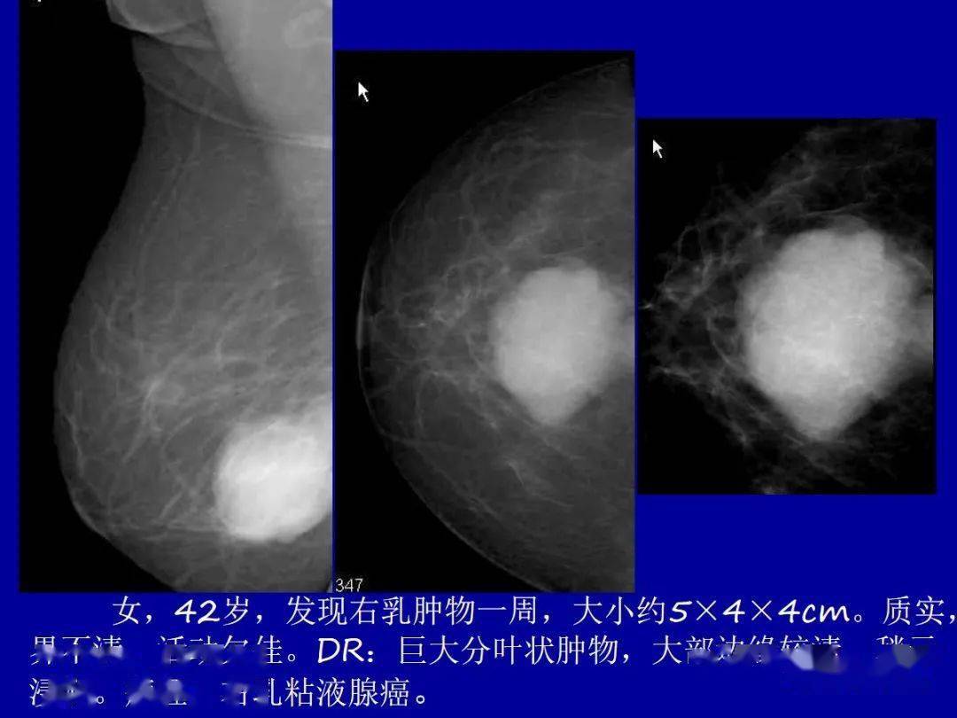 乳腺癌的影像诊断