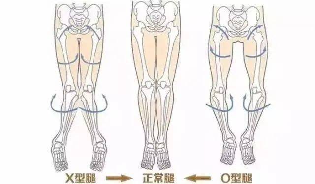 膝内翻,其膝关节成角是指向外侧的,因此经常会被误称为膝外翻.