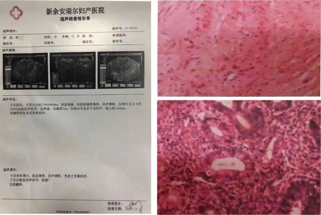 病理切片诊断李女士子宫多发性平滑肌瘤,子宫腺肌症