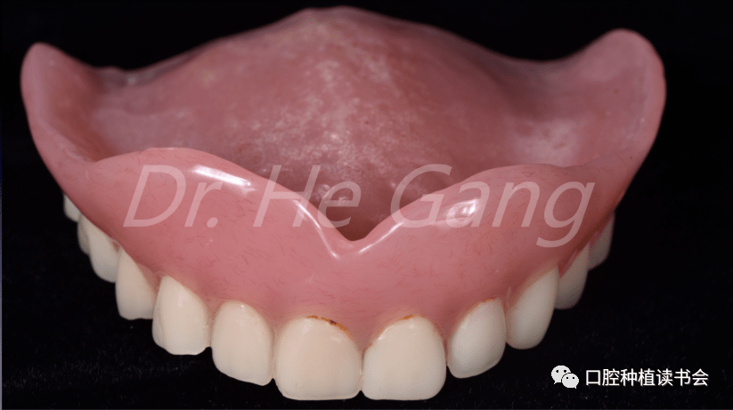 无牙颌种植大赏高龄无牙颌患者全颌即刻种植长期修复