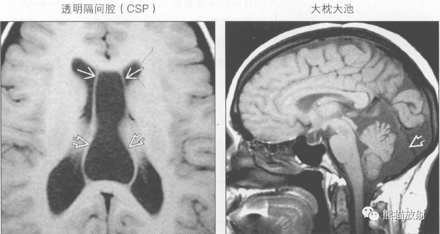 鉴别诊断丨脑池蛛网膜下腔正常变异