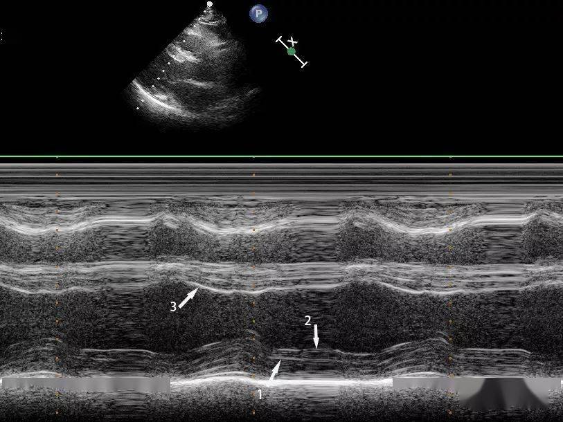 心肌病超声系列:心内膜胶原弹力纤维增生症