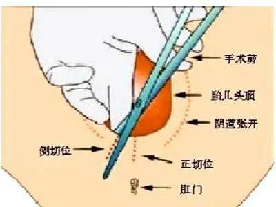 顺产时自然撕裂和侧切哪个恢复快有何区别和影响