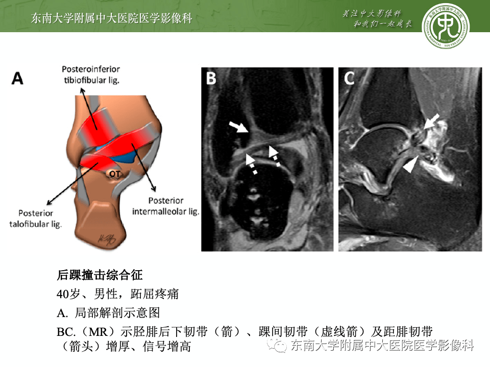 踝关节撞击综合征的诊断