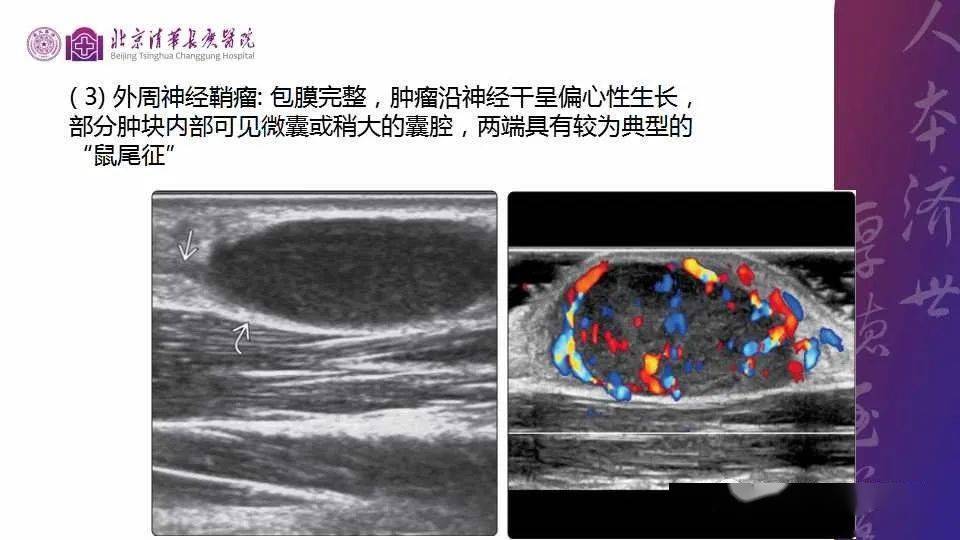 病例和文献复习:结节性筋膜炎