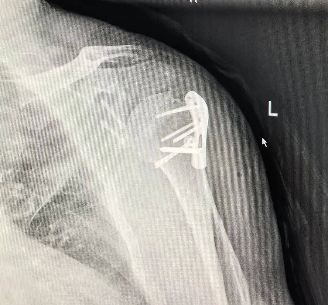 稳定性骨折需要手术吗 d333f1f377fd47cea4e5daa28514e1e2.jpeg