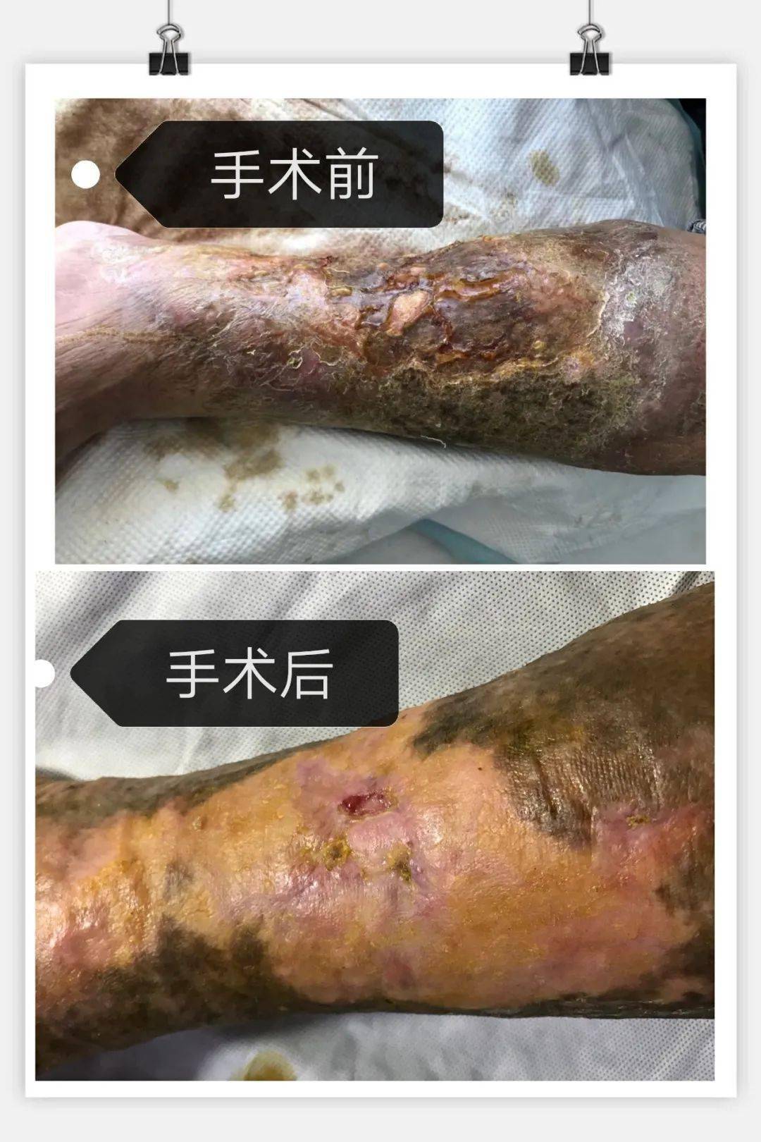 我院血管外科成功救治重度静脉炎静脉曲张溃疡患者
