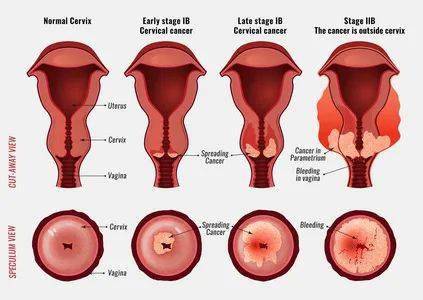 干货| 得了宫颈癌还能生育吗?切除子宫会加速衰老是真