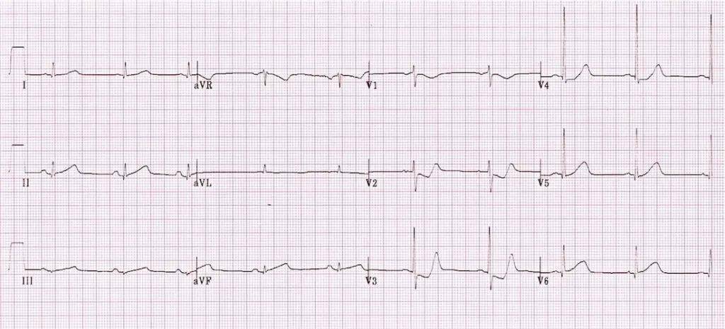 心肌缺血的心电图表现