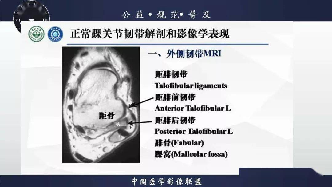 踝关节解剖及损伤mri诊断