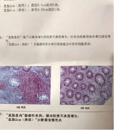 通俗解读——肠镜检查报告_绒毛状