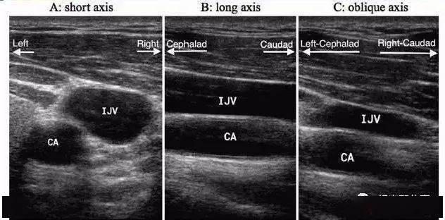 采用常规超声扫描颈内静脉:将探头置于右颈部环状软骨水平,观察到颈内