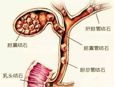 不吃早餐易患胆结石最后知道真相的我眼泪掉下来