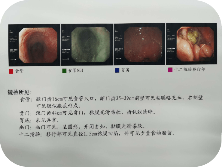 复查胃镜