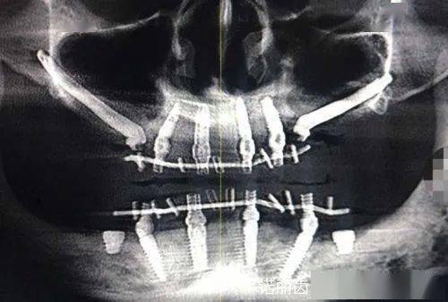 种植双侧穿颧骨全口种植
