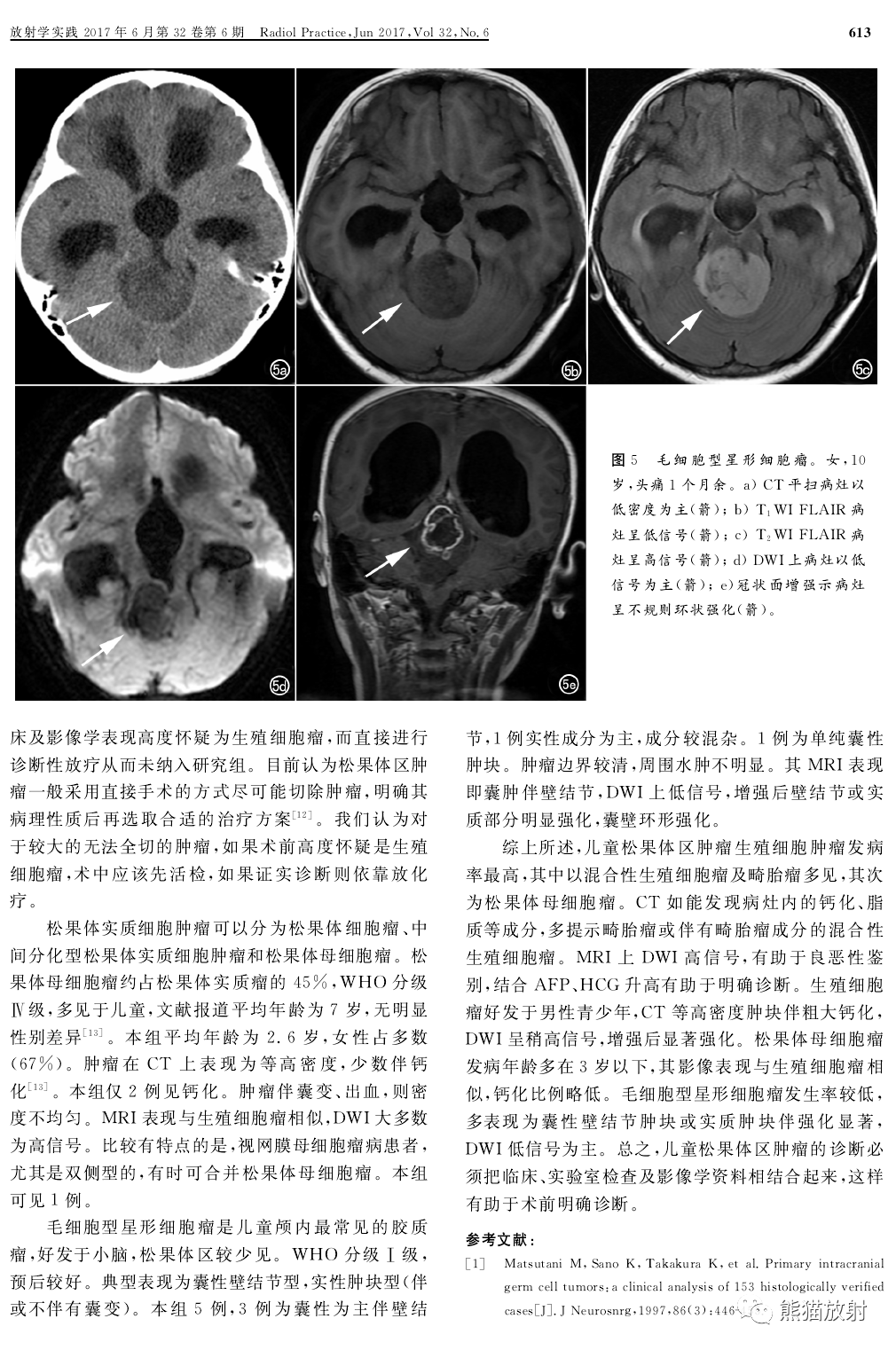 图文讲座丨儿童松果体区肿瘤的临床及影像学特征