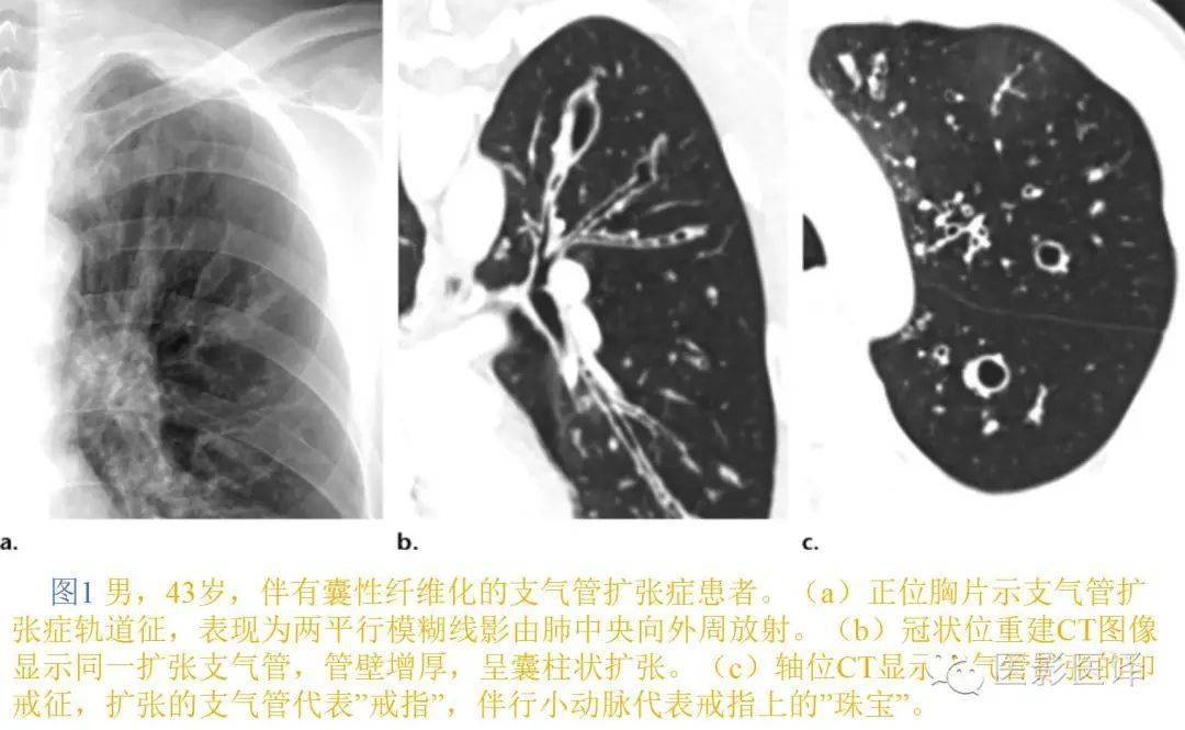【图文详析】支气管扩张的机制,影像特征和病因