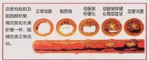 德国颠覆性研究:动脉硬化斑块并非来自血液中的脂肪