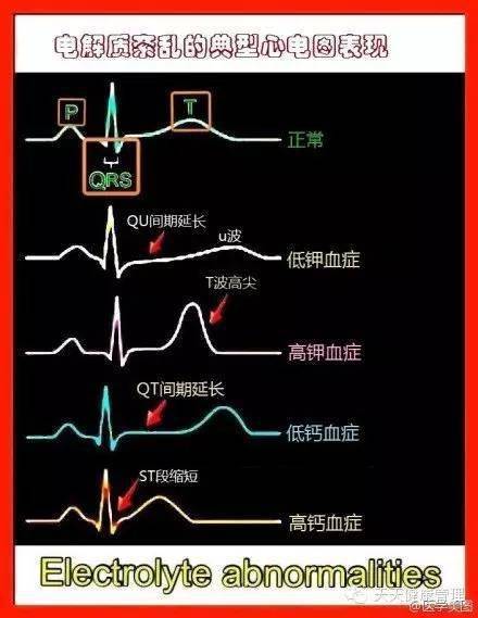 一张图记住不稳定心绞痛和心肌梗死的发病机理与鉴别 . .