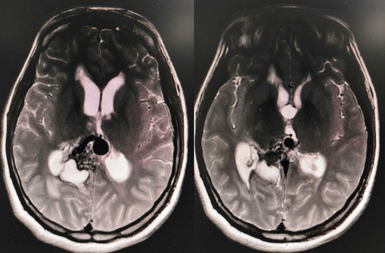 2018年9月头颅mri冠状位提示脑室体内血管流空影.