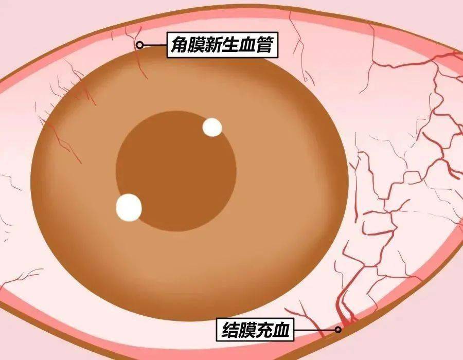 隐形和美瞳买不对会伤角膜这个指标一定要看