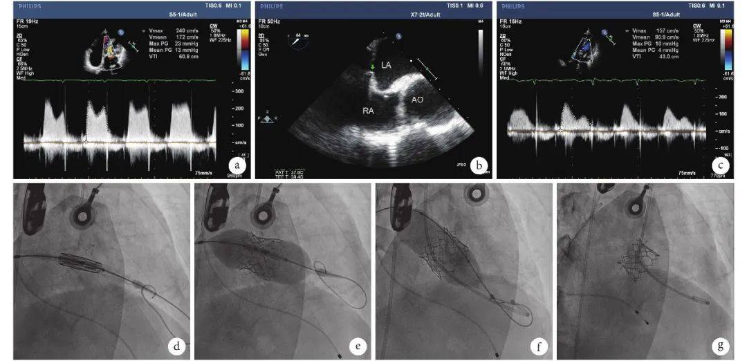 病例分享 | 股静脉-房间隔途径经导管二尖瓣置换术一例