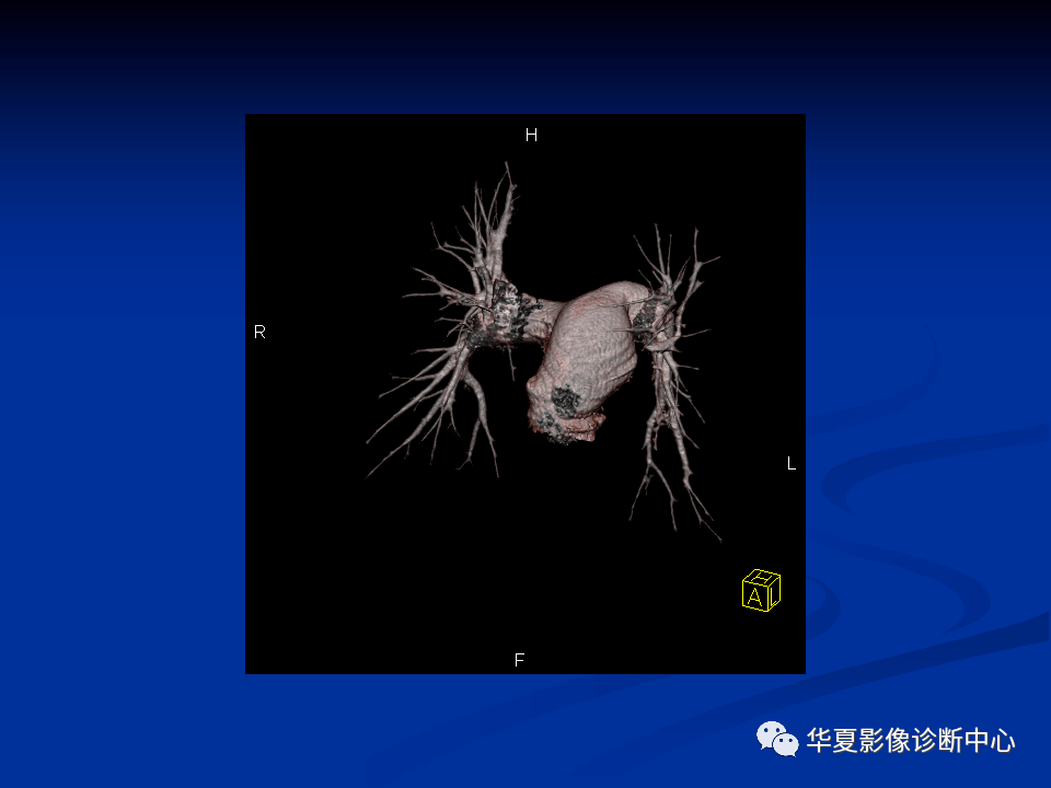 肺动脉常见病变的影像学表现