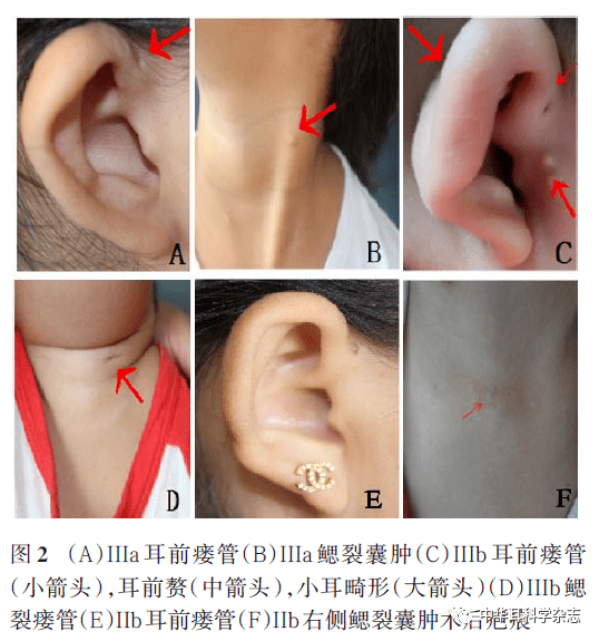 鳃耳综合征家系eya1基因一个新的无义突变