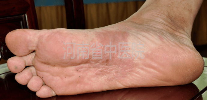 刘爱民教授皮肤病辨治典型案例分享(31)-足部湿疹1例