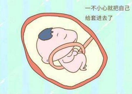 胎儿脐带绕颈一周怎么办才好 f1d2605c7de24a5bbec66822968a43aa.jpeg
