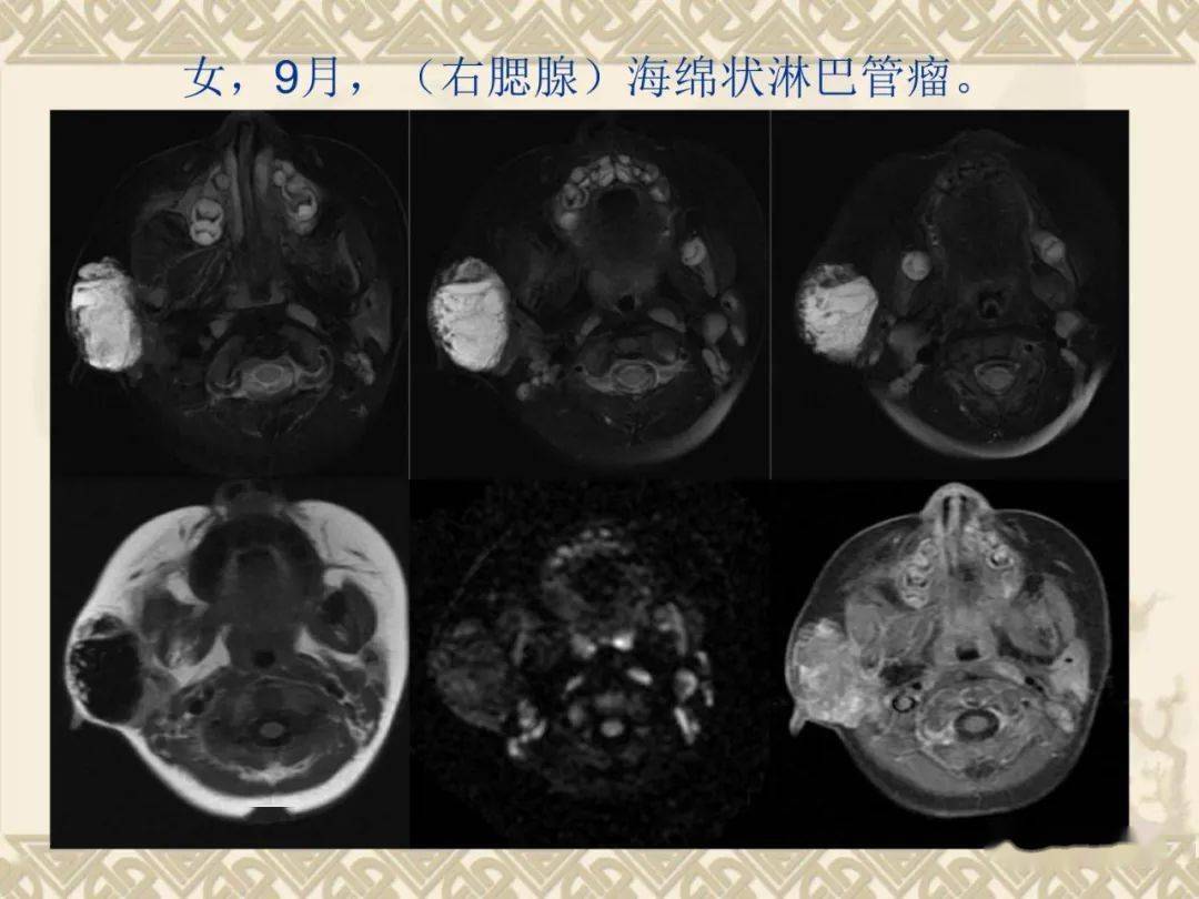 腮腺解剖及病变影像学表现