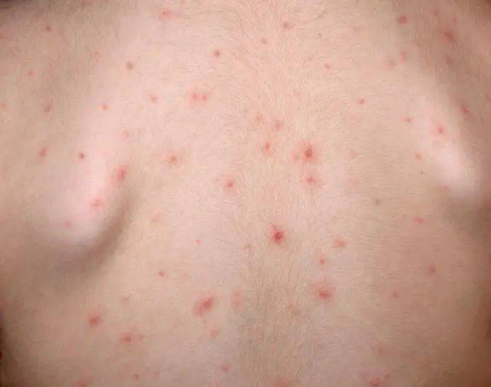 大多数儿童水痘症状较轻,仅表现为发热和皮疹,在家隔离,对症处理就