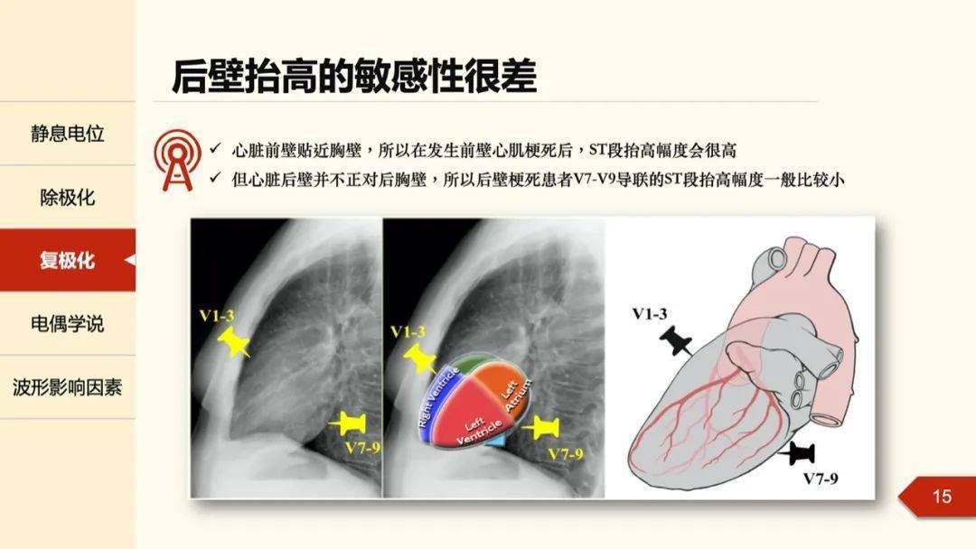 孔令秋教授正后壁心肌梗死的定位困惑及心电图线索