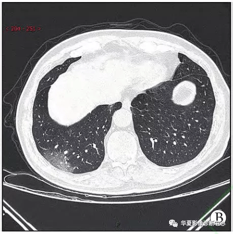 「影像进展」新冠肺炎的ct典型和不典型表现以及影像学分期