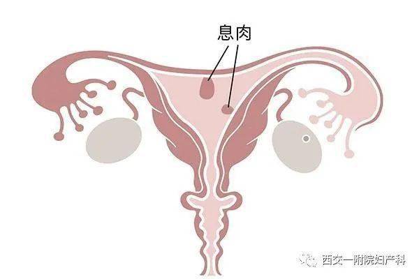 子宫内膜息肉影响怀孕吗?
