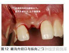 口腔种植手术学图解 组织切开与翻瓣