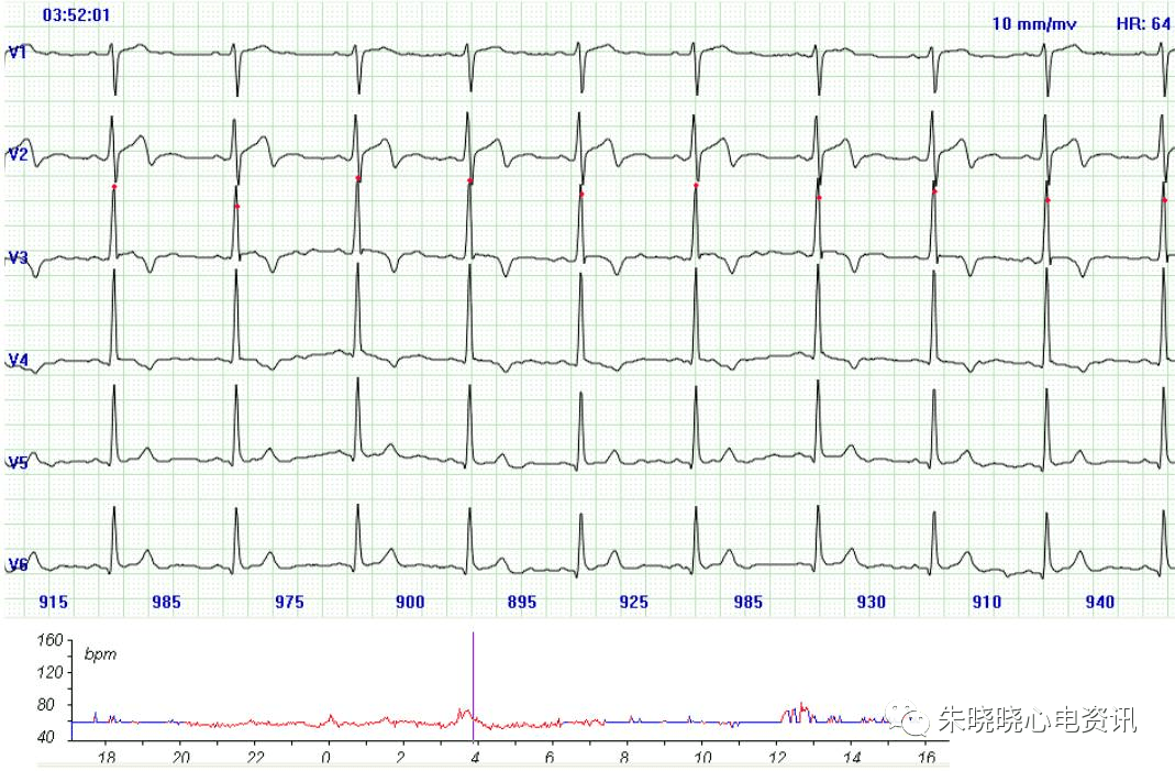 八大病例:教你看懂心肌缺血发作时的心电图表现