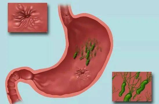 幽门螺旋杆菌感染后人体胃部会有哪些症状?
