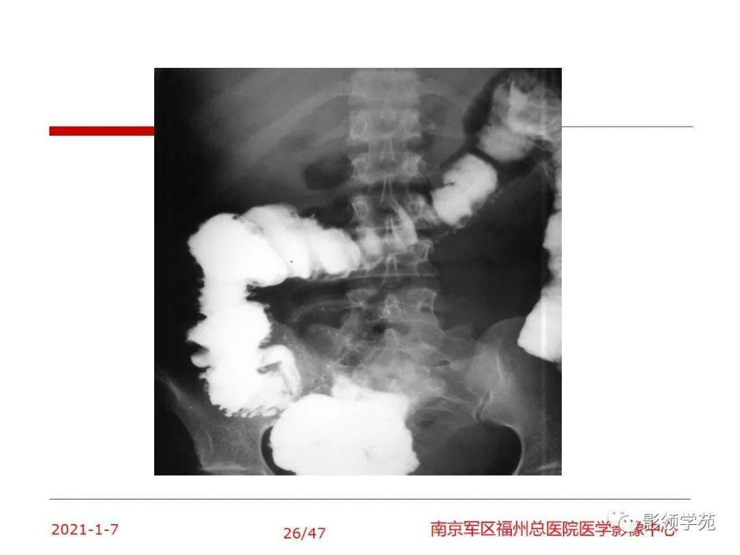 回盲部常见疾病及影像学表现