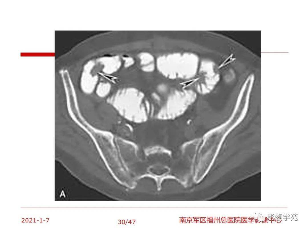 回盲部常见疾病及影像学表现_处理