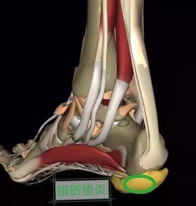 11类常见足跟痛的诊疗要点