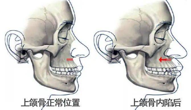 随着年龄增长,面部中间的上颌骨会开始内陷,使鼻唇沟越来越深