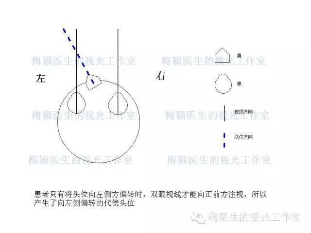 一图看懂三棱镜矫正眼球震颤代偿头位的方法