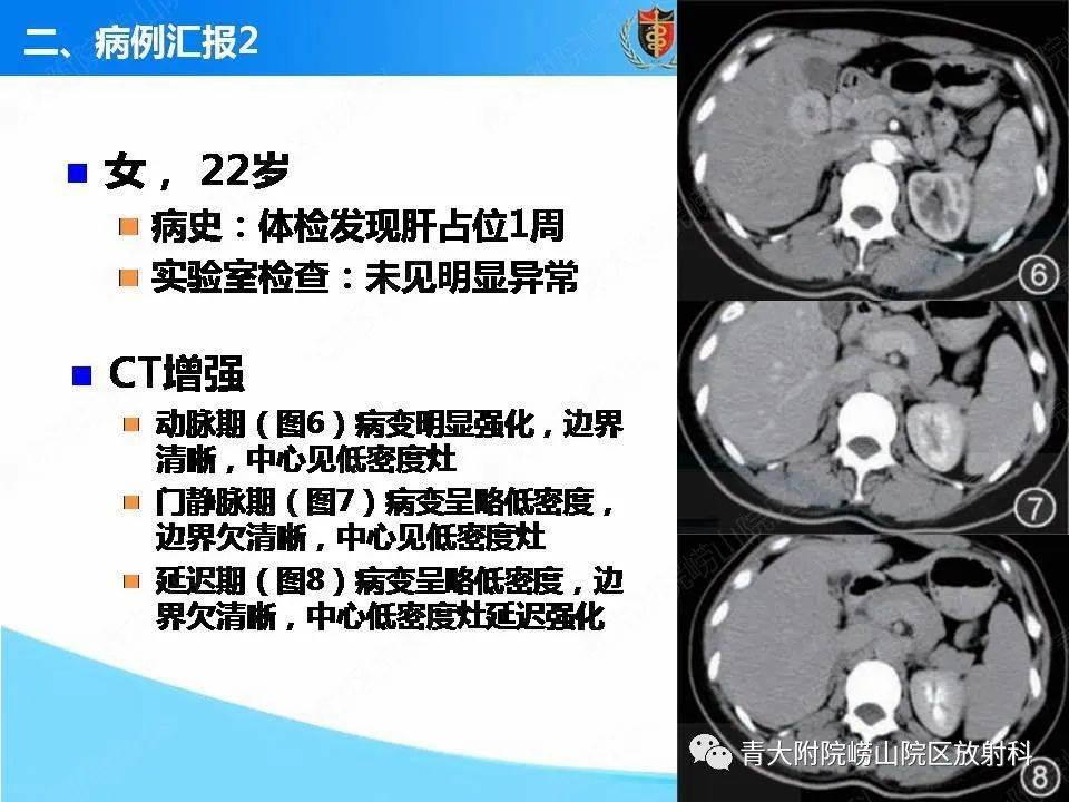 肝脏局灶性结节增生的ct及mri诊断及鉴别诊断要点