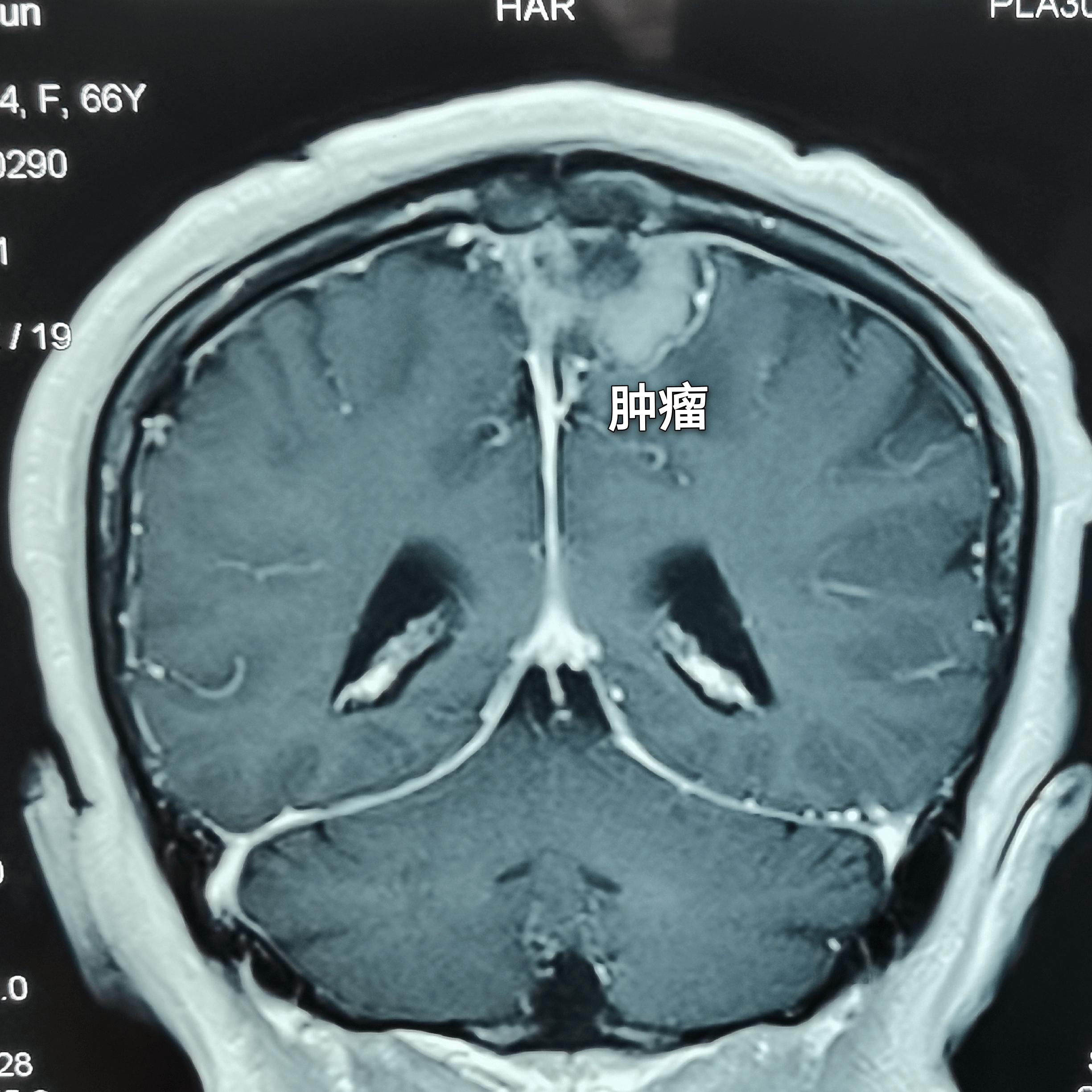 矢状窦旁脑膜瘤