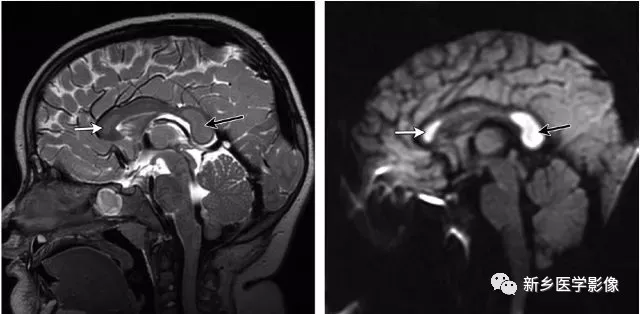 胼胝体怎么看正常 58576a9bd2314f318ad14af0a1500ce2.png